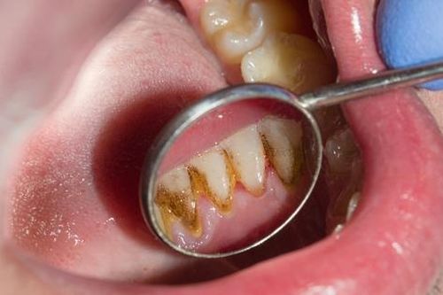Tại sao cao răng gây hôi miệng và cách phòng tránh mảng bám cao răng