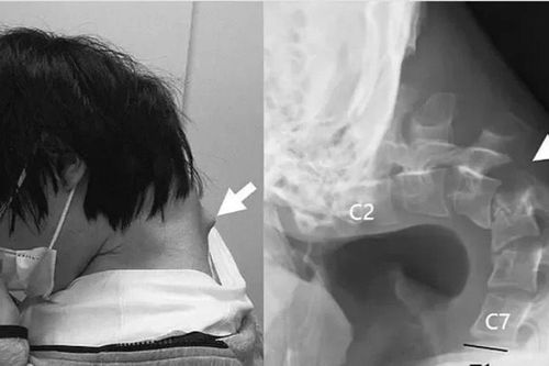 Thanh niên Nhật mắc 'hội chứng rụng đầu' vì lướt điện thoại quá nhiều