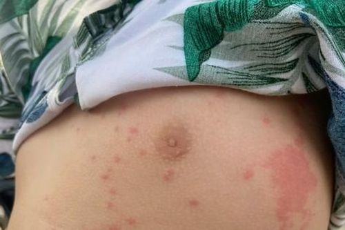 Nhiều người bị sứa lửa 'tấn công' khi tắm biển Nha Trang