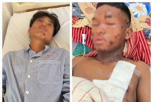 Nổ mìn tự chế khi đi đánh cá, hai thiếu niên bị thương nặng