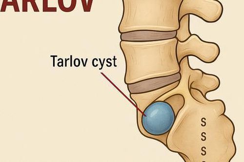 Nang Tarlov: Nguyên nhân, biểu hiện, cách điều trị và phòng bệnh