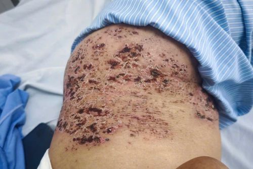 Zona thần kinh gây đau đớn ra sao?