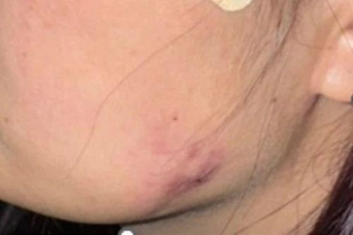 Mủ ứ đọng 2 bên má sau khi tiêm thon gọn hàm tại spa