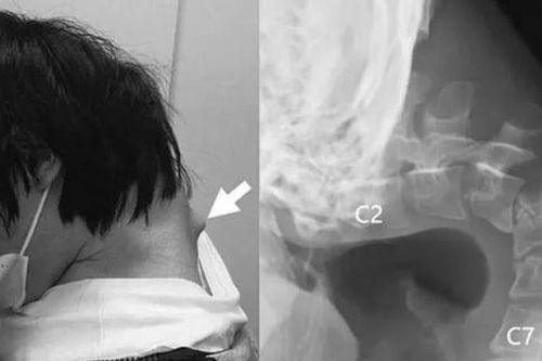 Thanh niên 25 tuổi mắc chứng 'rụng đầu' do nhìn điện thoại quá nhiều