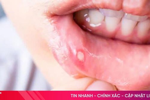 Nhiệt miệng mùa hè: Dấu hiệu cảnh báo cơ thể đang 'nóng trong'?