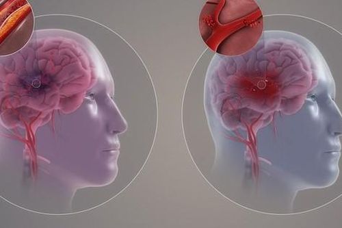 Phân loại bệnh mạch máu não và triệu chứng nhận biết sớm nhất