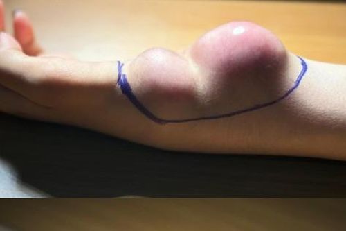 Đau cổ tay kéo dài, cô gái 23 tuổi bất ngờ phát hiện mắc ung thư