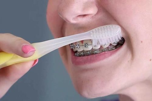Người phụ nữ biến chứng nghiêm trọng sau 2 năm niềng răng