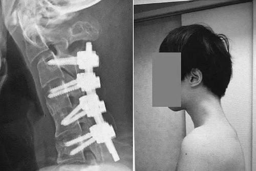 Thanh niên 25 tuổi mắc 'hội chứng cúi đầu' hiếm gặp vì nhìn điện thoại quá nhiều