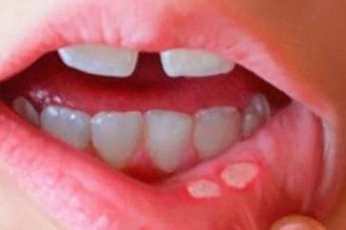 Lý do khiến trẻ bị nhiệt miệng và cách khắc phục
