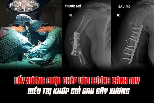 Phú Thọ: Trung tâm Y tế huyện Cẩm Khê phẫu thuật thành công ca ghép xương điều trị khớp giả