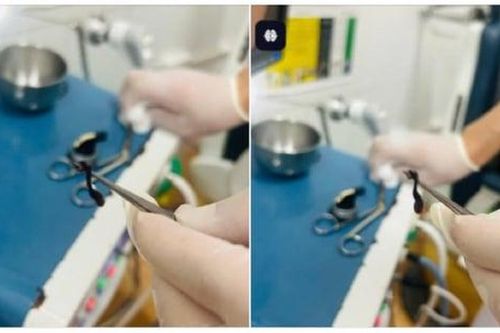 Đỉa rừng dài 5cm ký sinh trong mũi cháu bé 2 tuổi