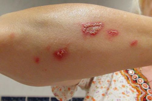 Mùa hè cảnh giác với bệnh da do côn trùng