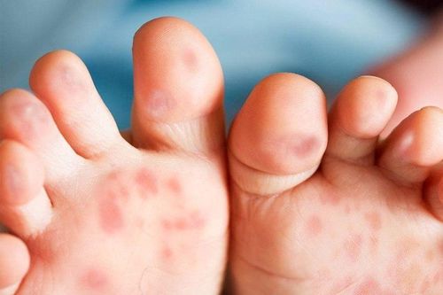 Trẻ chưa tiêm vaccine sởi, phụ huynh cần làm gì?