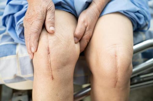 7 sai lầm hình thành sẹo lồi, sẹo phì đại: Cho vết thương tiếp xúc với ánh nắng