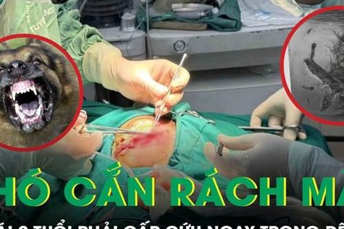 Cấp cứu ngay trong đêm cứu bé gái 2 tuổi bị chó nhà cắn rách mặt