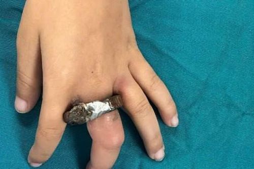 Vòng khóa siết ngón tay bé trai, gia đình cưa cửa mang đến viện