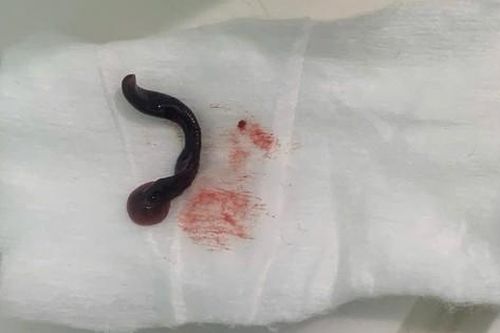 Con vắt dài 4cm sống trong mũi người đàn ông