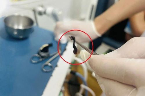Thấy chảy máu mũi kéo dài, bé trai đến viện bác sĩ gắp ra thứ 'đáng sợ'