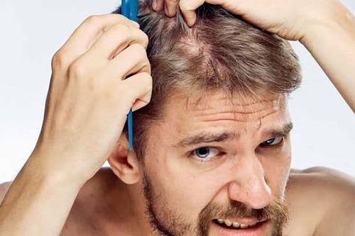 Rụng tóc ở nam giới và giải pháp khắc phục