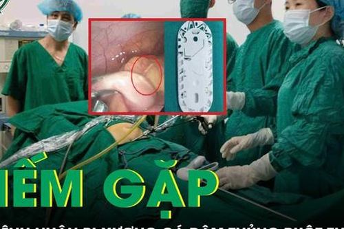 Hiếm gặp: Bệnh nhân bị xương cá đâm thủng ruột thừa, được phẫu thuật cứu sống