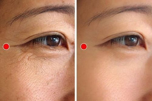 5 động tác đơn giản hằng ngày xóa mờ nếp nhăn đuôi mắt