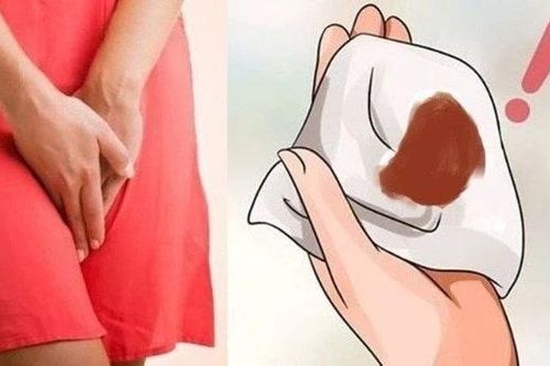 Máu kinh ra nhiều bất thường - dấu hiệu u xơ tử cung
