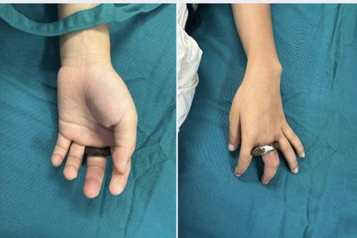Kẹt ngón tay vào vòng khóa cửa, bé trai nhập viện gấp với nguy cơ hoại tử