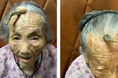 Cụ bà 107 tuổi bỗng mọc 'sừng' trên trán, cộng đồng mạng bàn tán đưa ra lời khuyên
