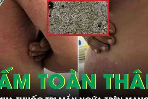 Tự ý mua thuốc trên mạng điều trị mẩn ngứa, người đàn ông bị nấm toàn thân