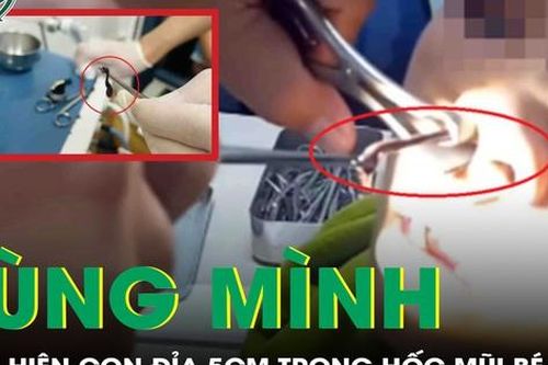 Đi khám vì chảy máu mũi, bé trai khiến bác sĩ rùng mình khi gắp ra 'dị vật'