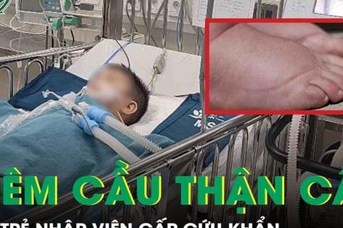 Phù mặt, sưng chân không rõ nguyên nhân, hai trẻ nhập viện khẩn viêm cầu thận cấp