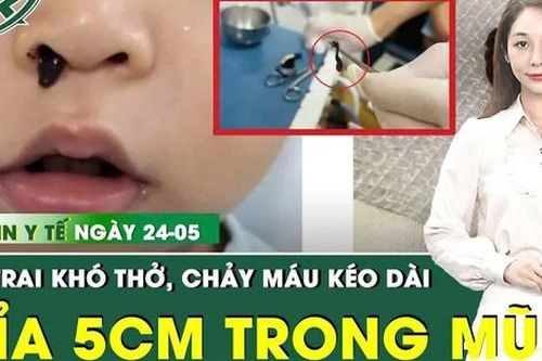 Bản Tin Y Tế 24/5: Chảy máu mũi kéo dài, gắp ra con đỉa dài 5cm trong mũi bé trai