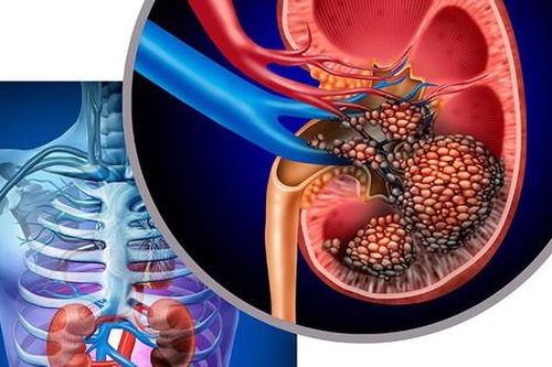 Người phụ nữ 46 tuổi ở TP HCM loại bỏ nguy cơ ung thư thận sớm từ 1 việc rất nhiều người Việt bỏ qua