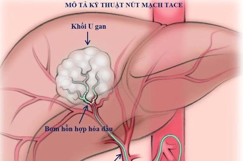 Gần 20% số ca ung thư ở nam giới là ung thư gan