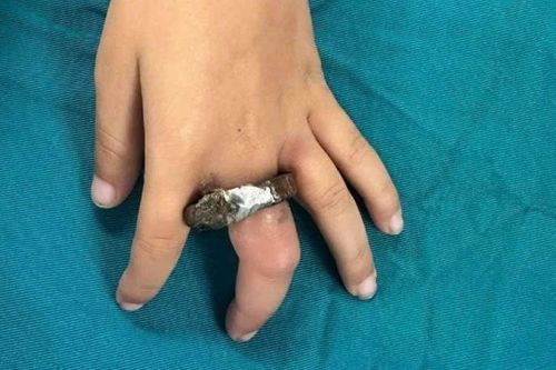 Suýt hoại tử ngón tay vì vòng khóa cửa