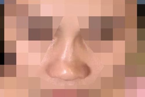 Sợ động dao kéo, nữ sinh nâng mũi bằng chỉ, 1 năm sau mũi biến dạng