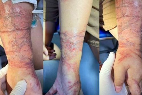 Bé gái viêm da nặng do tiếp xúc với sứa biển: Cách nhận biết sứa độc khi đi tắm biển