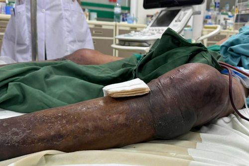 Chỉ từ vết gai đâm, người đàn ông nhập viện với hai chân tím đen, đang thập tử nhất sinh