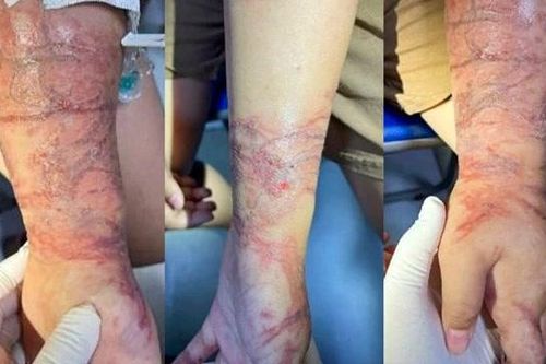 Bé gái viêm da do tiếp xúc với sứa