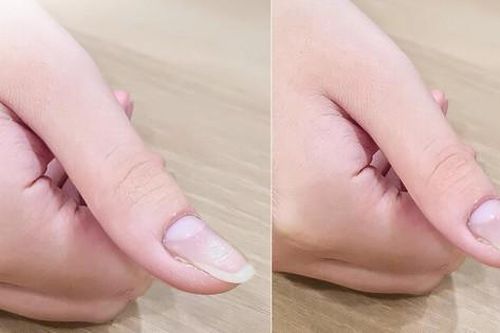 Đau ở ngón tay, bé 13 tuổi bất ngờ phát hiện bị u cuộn mạch, bác sĩ chỉ rõ có dấu hiệu này cần khám sớm