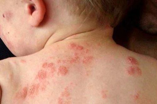 Trẻ bị viêm da dị ứng khi nào cần gặp bác sĩ?