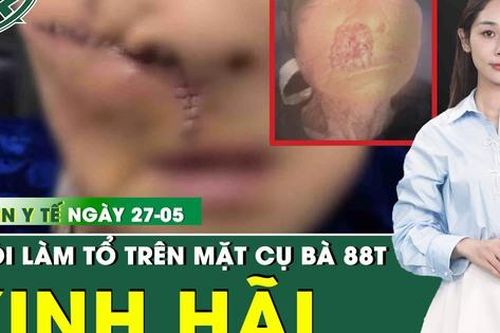 Bản tin Y tế 27/5: Giòi 'làm tổ' trong khối u trên mặt cụ bà 88 tuổi ở Quảng Nam