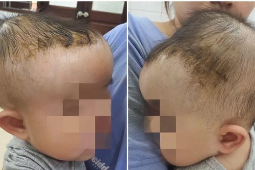 1 tuần sau ngã giường bé 7 tháng tuổi nguy kịch vì máu tụ