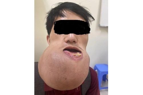 U xương khổng lồ khiến chàng trai ăn uống khó