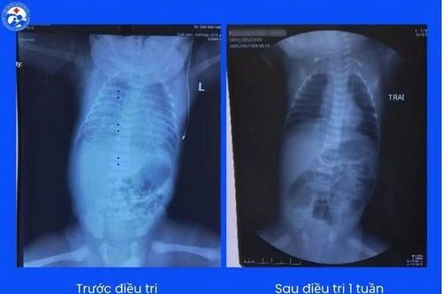 Bé sơ sinh bị suy hô hấp nặng hồi phục kỳ diệu
