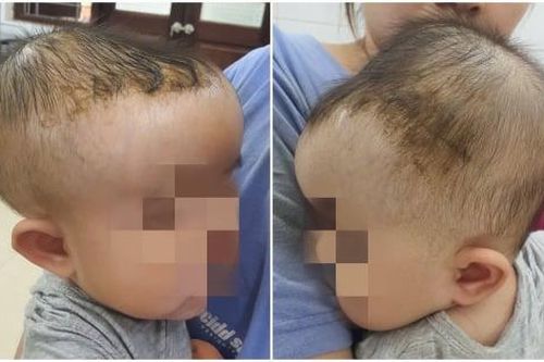 Bé 7 tháng tuổi bị tụ máu đầu do ngã từ trên giường xuống đất