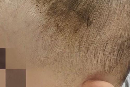 Bé 7 tuổi chấn thương nặng sau cú ngã tưởng vô hại