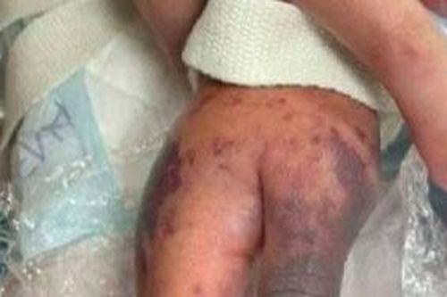 Bị ho sốt liên tục mà không khám, bé gái được chẩn đoán nhiễm 'vi khuẩn ăn thịt người'