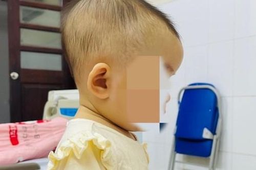 Bé 7 tháng tuổi tụ máu dưới da đầu từ cú ngã tưởng như vô hại